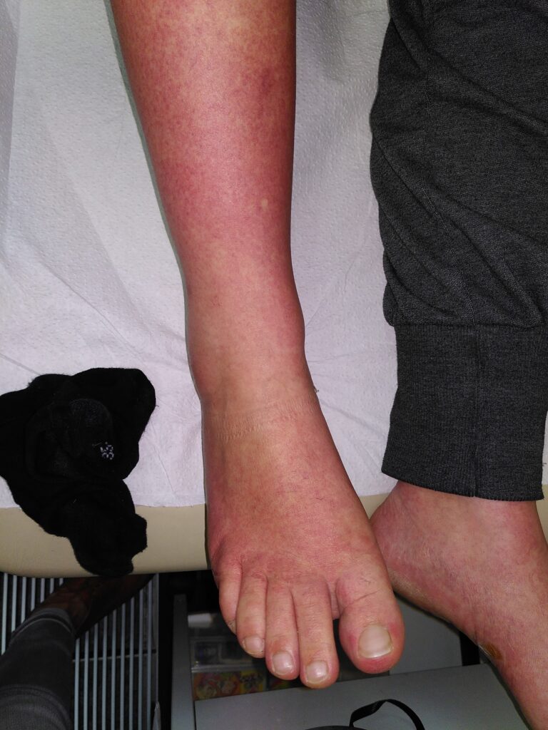 Quelle: Jelinek T. Dengue-Fieber. Reisemedizin up2date 2024; 01(01): 17 - 31. doi:10.1055/a-2176-0823
