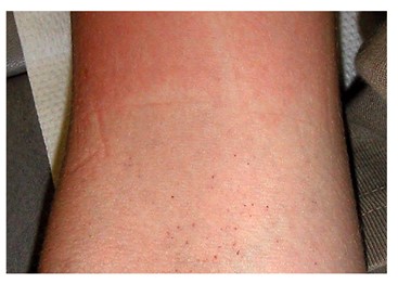 Quelle: Jelinek T. Dengue-Fieber. In: Jelinek T, Hrsg. Kursbuch Reisemedizin. 1. Aufl. Stuttgart: Thieme; 2012. doi:10.1055/b-002-41849.
